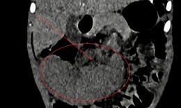 Phẫu thuật nội soi xử lý ca lách xoắn hiếm gặp ở trẻ 40 tháng tuổi