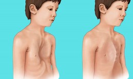 Thanh niên 18 tuổi mắc hội chứng Marfan biến chứng tim mạch nguy hiểm, bác sĩ cảnh báo dấu hiệu nhận biết sớm