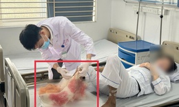 Suýt mất chân sau 1 tháng tự đắp lá chữa bỏng tại nhà