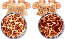 4 bí quyết giúp người lớn tuổi giảm nguy cơ loãng xương