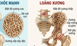 Phòng loãng xương cần hạn chế 5 loại thực phẩm này
