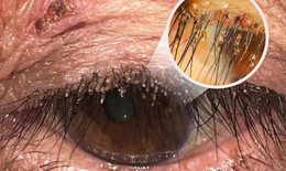Phát hiện ổ rận mu bám dày trên mí mắt người phụ nữ