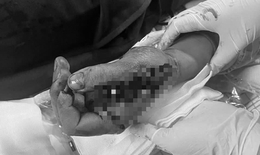 Tai nạn trong tích tắc vì pháo nổ, nam thanh niên suýt mất chức năng bàn tay