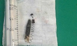 Phẫu thuật lấy dị vật lò xo bút bi 'ngủ quên' 13 năm trong vùng thái dương