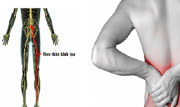 Vitamin và khoáng chất nào tốt cho người đau thần kinh tọa?