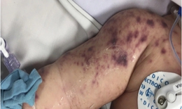 Sở Y tế An Giang xác nhận trẻ tử vong ở Phú Quốc do viêm não mô cầu