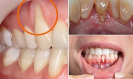 Tụt lợi có thực sự nguy hiểm?