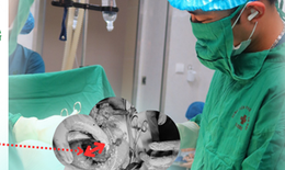 Giành lại sự sống cho bệnh nhân vỡ tử cung nguy kịch