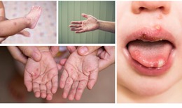 Gần 25.000 ca mắc tay chân miệng, tăng gấp 5 lần: Bộ Y tế chỉ đạo khẩn