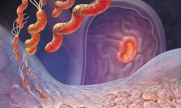 Viêm loét dạ dày – tá tràng: Dùng thuốc đúng cách để bảo vệ niêm mạc