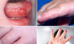 Trẻ mắc tay chân miệng chỉ sốt, loét miệng, không có nhiều mụn nước vẫn có nguy cơ diễn biến nặng nhanh chóng