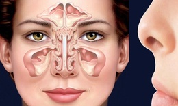 Đau hốc mắt kéo dài, coi chừng viêm xoang trán