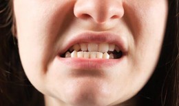 Lệch khớp cắn có gây bệnh lý răng miệng?