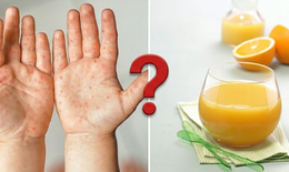 Nước cam tốt nhưng trẻ tay chân miệng nên tránh: Chuyên gia giải thích lý do