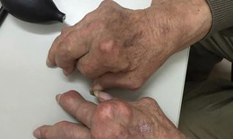 Gout mạn tính gây biến dạng khớp tay, chân xử trí ra sao?
