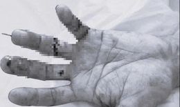 5 giờ liên tục bác sĩ viện tỉnh nối thành công ngón tay đứt lìa cho bệnh nhân