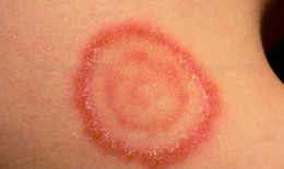 Cảnh giác nấm da lây từ chó, mèo