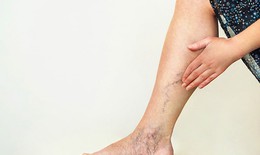 Yếu tố nguy cơ không nên xem nhẹ của suy tĩnh mạch chi dưới