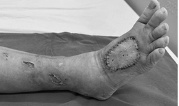 Cứu bàn chân bên bờ cắt cụt cho bệnh nhân đái tháo đường 20 năm