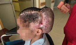 Đột quỵ sau cấy mỡ tự thân, nữ bệnh nhân phải tái tạo hộp sọ