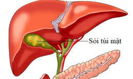 Dấu hiệu cảnh báo sỏi túi mật, nhận biết sớm để tránh biến chứng nguy hiểm