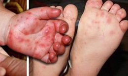 Tay chân miệng ở Khánh Hòa tăng gấp 4 lần năm ngoái, bác sĩ khuyến cáo điều phụ huynh cần làm ngay