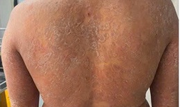 Dùng sai thuốc, nấm da lan toàn thân, ngứa dữ dội