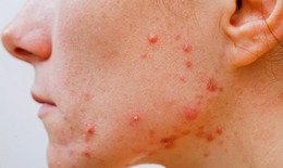 7 yếu tố dẫn đến tình trạng mụn viêm trên da