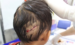 Bé 4 tuổi bị chó nhà cắn, nhiều vết thương nặng ở đầu và tay