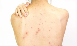 Nguyên nhân mọc mụn trứng cá ở lưng, yếu tố thường gặp nhưng dễ bị bỏ qua