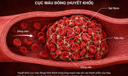 2 cách đơn giản ngăn ngừa cục máu đông