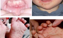 95% ca bệnh tay chân miệng là nhóm trẻ dưới 5 tuổi, Lâm Đồng khẩn trương triển khai ‘3 sạch’ trong trường học