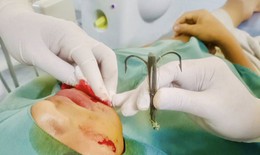 Đi câu cá, lưỡi câu móc vào má