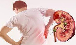 Sỏi thận có thể tự đào thải trong bao lâu, khi nào cần can thiệp?