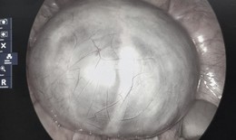 Chủ quan với cơn đau bụng, phát hiện u buồng trứng 14cm