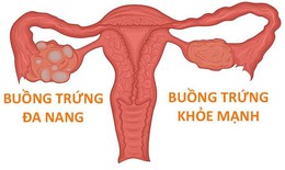 Phụ nữ mắc hội chứng buồng trứng đa nang có mang thai được không?