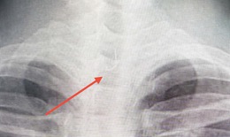Sau ăn cá người đàn ông 46 tuổi bị mắc lưỡi câu sâu trong thực quản