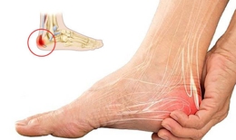 Biểu hiện điển hình khi mắc gai gót chân, đừng chủ quan với những cơn đau ở bàn chân