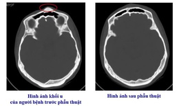 Bệnh viện Việt Nam - Thụy Điển Uông Bí phẫu thuật thành công ca u xương sọ hiếm gặp