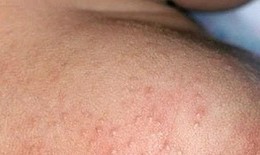 Mùa hè nhiều rôm sảy cần xử trí ra sao?