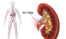Nhập viện vì sỏi thận, chuyên gia khuyến cáo cần phát hiện sớm khi có biểu hiện này