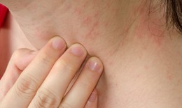 Mẩn ngứa ở trẻ cần xử trí như thế nào?