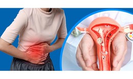 7 dấu hiệu thường gặp của lạc nội mạc tử cung chị em nên chú ý