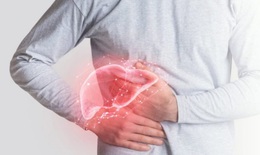 Chủ quan khi mắc xơ gan, nhiều biến chứng đe dọa tính mạng