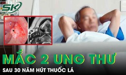 Người đàn ông 56 tuổi mắc cùng lúc hai ung thư sau 30 năm hút thuốc lá