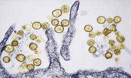 Hantavirus khiến 3 người trên du thuyền MV Hondius tử vong nguy hiểm ra sao?