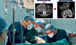 U gan 2 cm 'phình' lên 20 cm do tự điều trị bằng thuốc nam