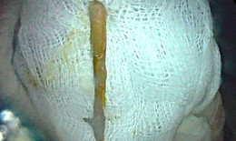 Đi cấp cứu vì tiêu chảy ra máu, phát hiện dị vật dài 3cm đâm thủng đại tràng