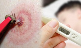 Suy đa tạng do mò đốt, đặc trưng của bệnh sốt mò cần biết