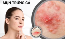 Mụn trứng cá kéo dài tới tuổi nào mới hết?